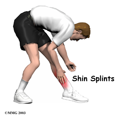 Shin Splints