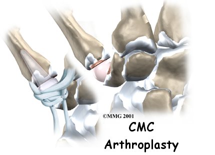 Artificial Joint Replacement of the Thumb - Impact Physio & Sport Clinic's Guide