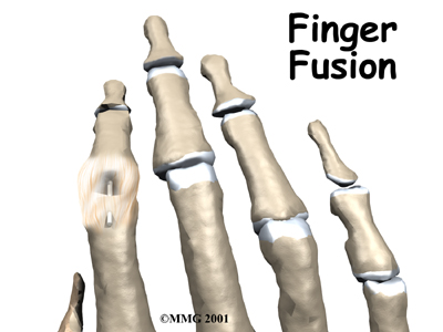 Finger Fusion Surgery - Impact Physio & Sport Clinic's Guide