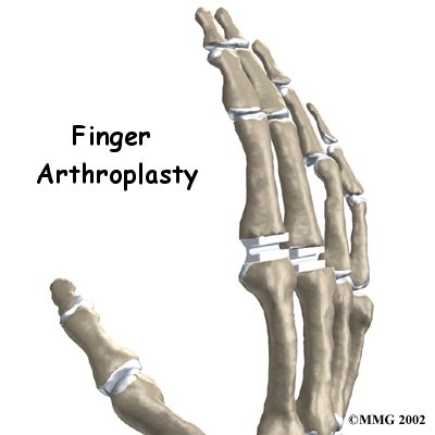 Artificial Joint Replacement of the Finger - Impact Physio & Sport Clinic's Guide