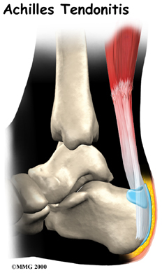 Guide to Tendonitis